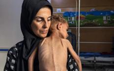 466 وفاة بالتجويع في غزة منذ 2024.. بينهم 157 طفلا