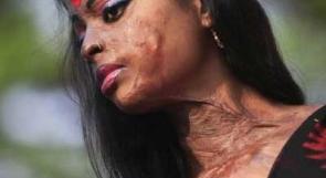 هندي يحرق وجه فتاة بالماء المغلي لأنها ألغت صداقته على فيسبوك