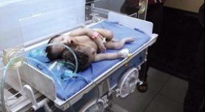 ولادة طفل برأسين في جنوب العراق