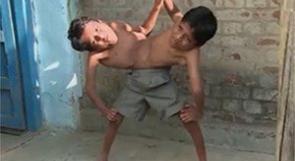 بالفيديو.. توأمان هنديان ملتصقان بجسدين وعلى "ساقين فقط"