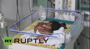 بالفيديو...حالة نادرة..ولادة توأم طفيلي من دون رأس وصدر في الهند