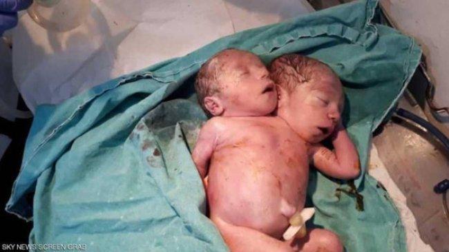 ليست الأولى.. ولادة طفل برأسين في إدلب السورية