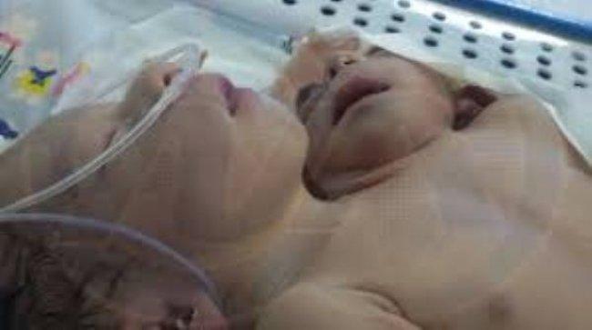 ولادة طفلة برأسين وأربعة أذرع في مصر