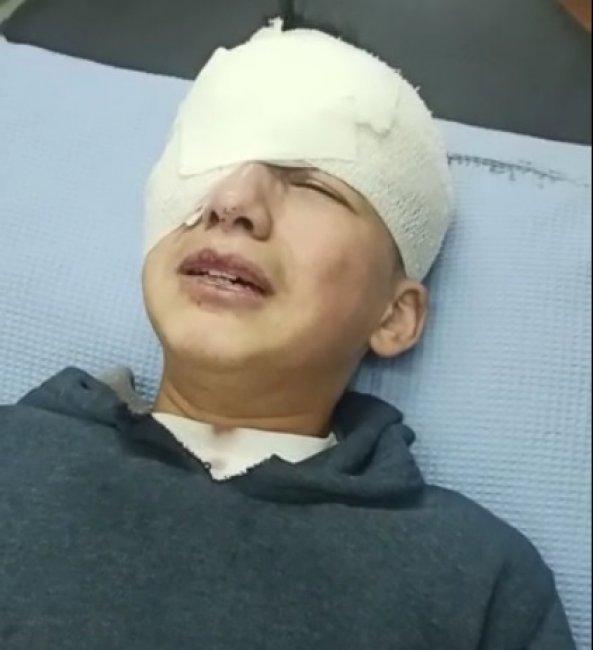 طفل في الخليل يفقد عينه بعد اصابته برصاصة من جيش الاحتلال - وكالة وطن  للأنباء